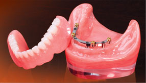 implant-denture-img